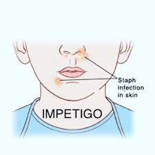 impetigo consultation by clockwork pharmacy